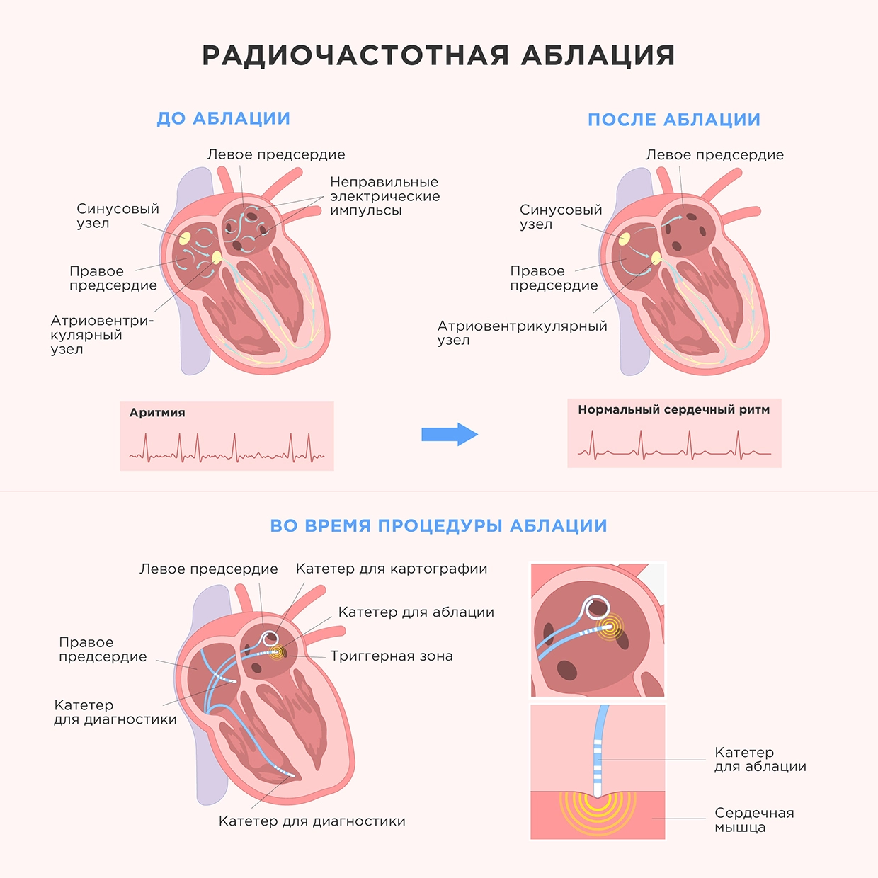 Радиочастотная аблация (РЧА) при аритмии